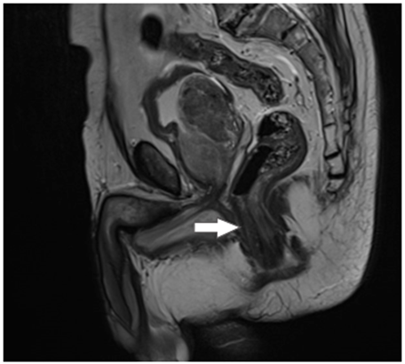 Se muestra corte sagital de resonancia magn&eacute;tica contrastada del paciente en la regi&oacute;n abdominop&eacute;lvica donde se observa engrosamiento de la pared del recto (flecha), sin lesi&oacute;n residual.