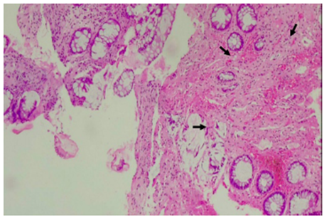 40X. Los cortes histol&oacute;gicos revelan mucosa colorrectal con marcada disminuci&oacute;n del componente glandular, rodeada por una l&aacute;mina propia con marcada fibrosis (flechas), sin evidencia de lesi&oacute;n residual.