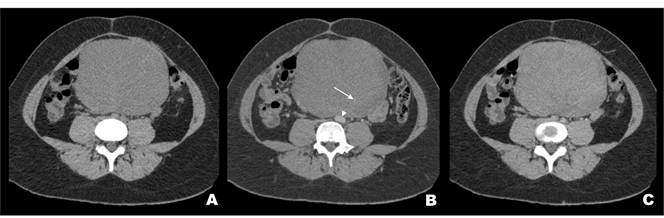 Tomografía computarizada de abdomen y pelvis. El tumor presenta estructuras vasculares en su interior (flecha), mide 15 x 16 x 16 cm, es hipodenso y homogéneo, genera desplazamiento de asas intestinales y compresión de la aorta abdominal y la vena cava inferior (cabezas de flecha).