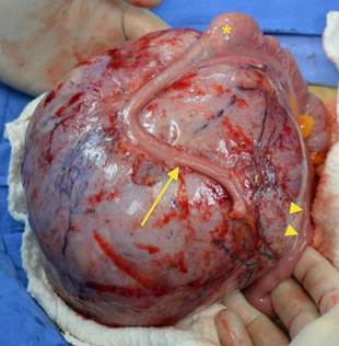 Imagen intraoperatoria en la que se observa el tumor del mesenterio íntimamente adherido al apéndice cecal (flecha), íleon terminal (cabezas de flecha) y ciego (asterisco).