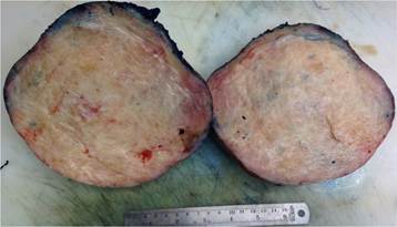 Pieza macroscópica. Muestra en su interior un aspecto arremolinado blanquecino, con áreas fibrosas y áreas edematosas.