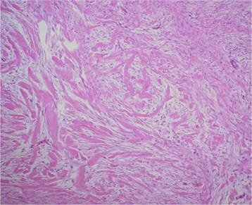 Microfotografía que muestra la proliferación mesenquimática entremezclada con gruesos haces de colágeno. Hematoxilina & eosina. 10x.