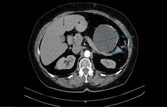 Corte axial de tomograf&iacute;a computarizada contrastada de abdomen (plano transverso). Se se&ntilde;ala la lesi&oacute;n hipodensa de aspecto qu&iacute;stico de 86.6 mm x 78.5 mm.