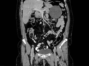 Corte coronal de la tomograf&iacute;a computarizada de abdomen donde se se&ntilde;ala la lesi&oacute;n hipodensa de aspecto qu&iacute;stico.