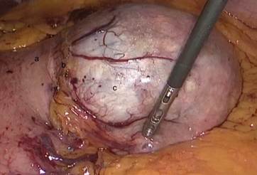 Hallazgos intraoperatorios: curvatura menor del est&oacute;mago (a) en cuyo espesor de la pared (b) se identifica una lesi&oacute;n qu&iacute;stica (c) con la que comparten una misma irrigaci&oacute;n sangu&iacute;nea.