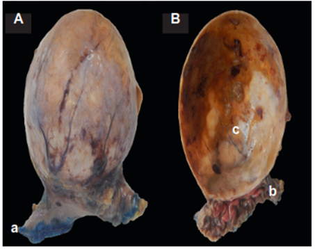Hallazgos macrosc&oacute;picos en esp&eacute;cimen de resecci&oacute;n: A. Cara externa de lesi&oacute;n qu&iacute;stica unida a borde de resecci&oacute;n de pared g&aacute;strica (a). B. Cara interna del esp&eacute;cimen de resecci&oacute;n con fragmentos de mucosa g&aacute;strica (b) y cavidad interna de lesi&oacute;n qu&iacute;stica no comunicante (c).