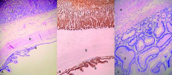 Hallazgos microsc&oacute;picos: A. Epitelio de pared qu&iacute;stica (a) unido por capa de m&uacute;sculo liso (b) a mucosa g&aacute;strica (c). B. Epitelios de pared qu&iacute;stica y g&aacute;strica positivos para CK AE1/AE3 por inmunohistoqu&iacute;mica. C. Mucosa intestinal tapizando la cara interna de la lesi&oacute;n qu&iacute;stica (d).