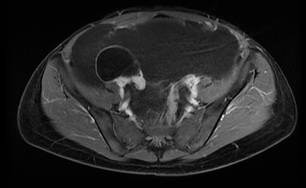 Resonancia magn&eacute;tica abdominal en corte T1 con supresi&oacute;n grasa post contraste (corte axial). La trompa derecha est&aacute; adherida a la lesi&oacute;n qu&iacute;stica pura, sin contenido prote&iacute;nico ni sanguinolento, que aparentemente corresponde a la lesi&oacute;n qu&iacute;stica inicial de la paciente.