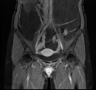 Resonancia magn&eacute;tica abdominal en corte T1 con supresi&oacute;n grasa post contraste (corte coronal). Se observa la primera lesi&oacute;n qu&iacute;stica en la trompa derecha.