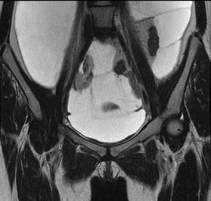 Resonancia magn&eacute;tica abdominal en corte coronal T2 con supresi&oacute;n grasa. Se observa el origen del primer quiste en la trompa de Falopio derecha.