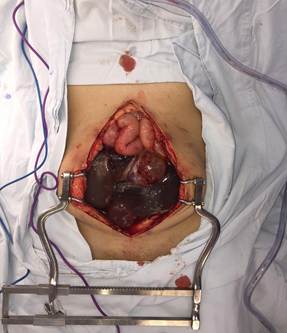 Laparotom&iacute;a mediana supra e infraumbilical. Se observa la exposici&oacute;n de las asas de intestino delgado rechazadas en sentido cef&aacute;lico por los quistes mesoteliales.