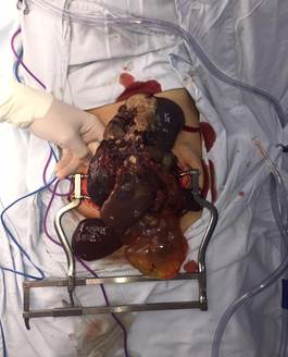 Resecci&oacute;n de quistes mediante laparotom&iacute;a, se visualizan m&uacute;ltiples quistes con diferente contenido, hemorr&aacute;gico y seroso.