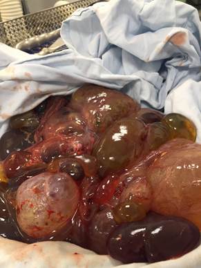 Detalle de los quistes resecados. Se observan las paredes y sus componentes.