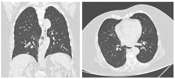 Tomografía de tórax de alta resolución compatible con CO-RADS 2.
