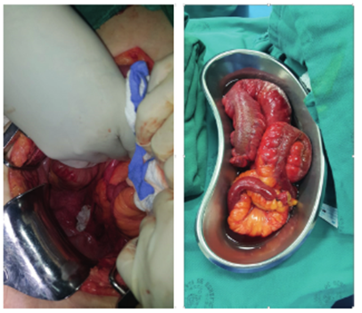 En la cirugía se aprecia el defecto herniario interrectovaginal por donde protruyeron asas intestinales (izquierda), que fueron resecadas por encontrarse con signos de hipoperfusión y necrosis (derecha).
