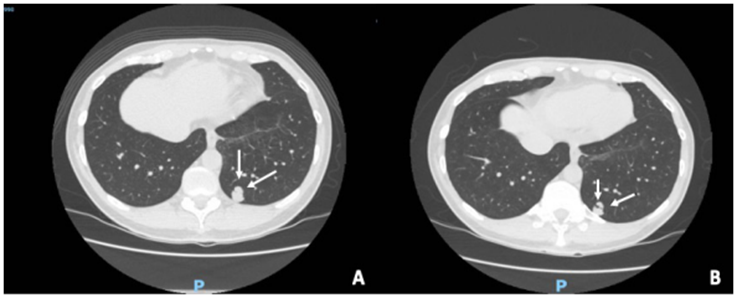 Paciente en seguimiento de nódulo pulmonar. A. Tomografía axial computarizada del año 2018, donde se identificó un nódulo (flechas), al cual se realizó biopsia percutánea, con reporte de patología negativo para malignidad. B. Hallazgos imagenológicos del mismo nódulo pulmonar a los 2 años de seguimiento, sin cambios respecto a estudio previo.