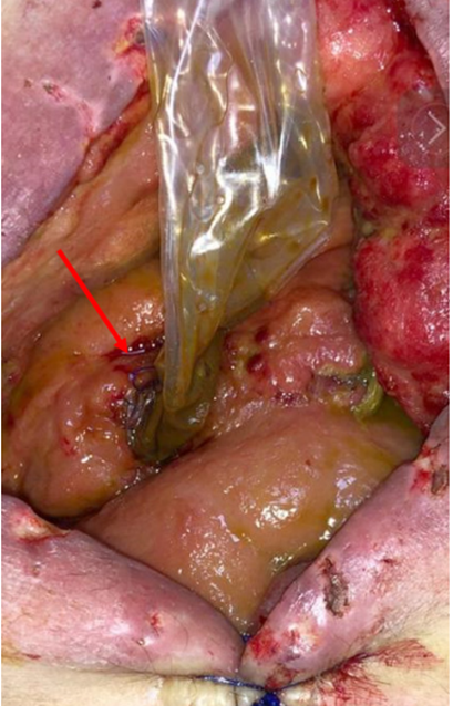 Técnica de manejo de fístulas por principio de capilaridad, la flecha indica el sitio de sutura del tubo de látex a la fístula de intestino delgado.