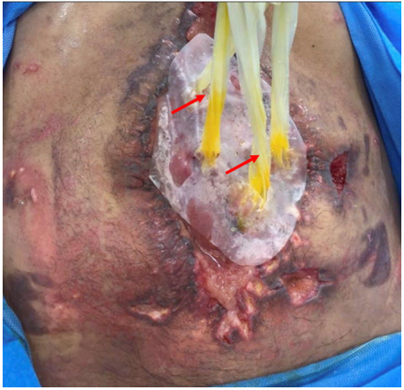 Técnica de manejo de fístulas por principio de capilaridad, las flechas indican el nivel de líquido que sube por el tubo de látex.