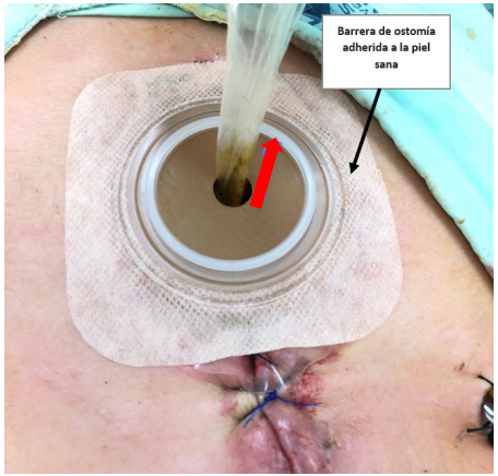 Técnica de manejo de fístulas por principio de capilaridad. La flecha roja indica la dirección del nivel de líquido que sube por el tubo de látex el cual emerge por la barrera de ostomía protegiendo la piel y el tejido periostomal.