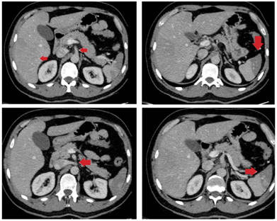 Tomografía computarizada abdominal con contraste venoso. Se observan múltiples infartos esplénicos y trastorno de la perfusión hepática que tienen aparente origen en un defecto de llenado lineal del tronco celíaco (flechas).