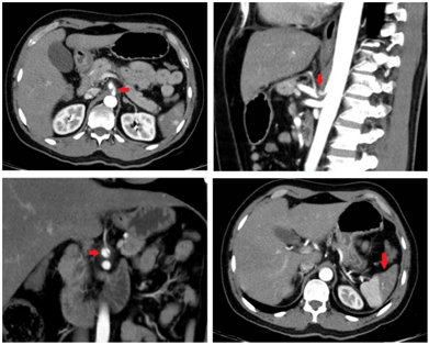 Disección contenida del tronco celíaco autolimitada en la arteria hepática común después del origen de la arteria gástrica izquierda y antes del origen de la arteria gastroduodenal (flecha roja). No se observan aneurismas o placas ateromatosas, se observan áreas de infarto esplénico.