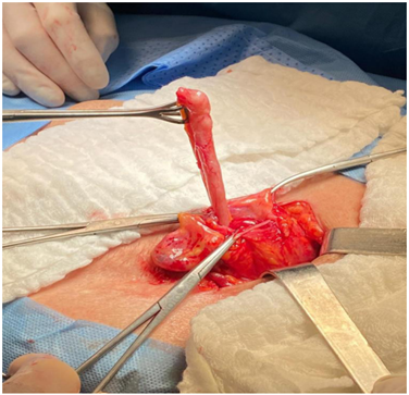 Apéndice cecal con hiperemia, contenida en el saco herniario femoral derecho.