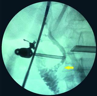 Colangiografia intraoperatoria donde se aprecian varios defectos de llenamiento (flecha) correspondientes a calculos.