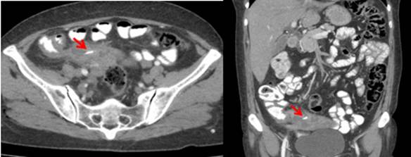 Tomografia computarizada de abdomen con contraste, la flecha señala el cuerpo extraño.