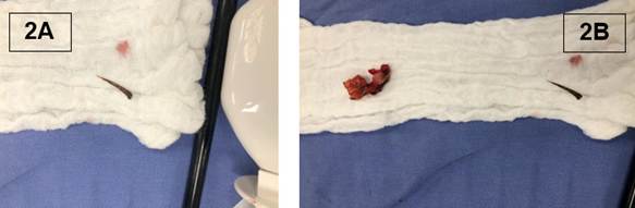 A cuerpo extraño identificado en apéndice cecal. B apéndice cecal y cuerpo extraño.