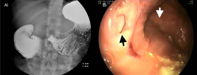 A) Segundo estudio de tránsito gastrointestinal con bario, donde se observa un divertículo duodenal intraluminal gigante, que condiciona oclusión duodenal con dilatación del duodeno proximal. B) En la endoscopia, la flecha blanca marca el saco del divertículo y la flecha negra, la verdadera luz duodenal.
