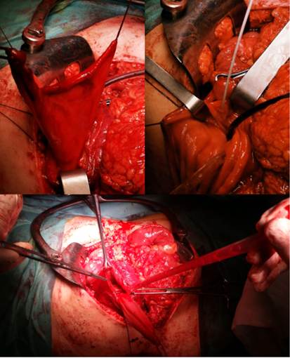 Tras realizar duodenotomía se observa un gran divertículo cercano a la papila, que precisó la inserción de una sonda como tutor previo a la realización de diverticulectomía.