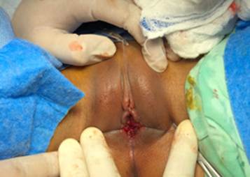 T&eacute;cnica de Kelly Burnham modificada o escisi&oacute;n de cuatro cuadrantes.