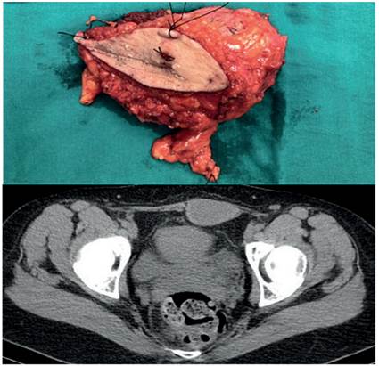 Caso cl&iacute;nico 1, femenina de 22 a&ntilde;os, en la parte superior se observa la masa resecada, en la parte inferior se presenta la resonancia. Fuente: Hospital Miguel Servet, Servicio de cirug&iacute;a general.