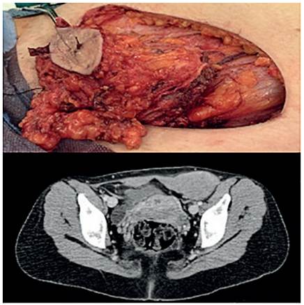 Caso cl&iacute;nico 2, femenina de 32 a&ntilde;os, en la parte superior se muestra la masa resecada, en la parte inferior se observa la resonancia. Fuente: Hospital Miguel Servet, Servicio de cirug&iacute;a general.