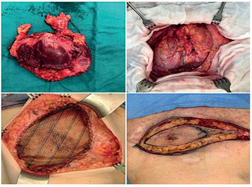 Caso cl&iacute;nico 3, femenina de 34 a&ntilde;os, en la parte superior se aprecian la masa resecada y el defecto de la pared, y en la parte inferior se observan las im&aacute;genes de la reconstrucci&oacute;n con malla. Fuente: Hospital Miguel Servet, Servicio de cirug&iacute;a general.