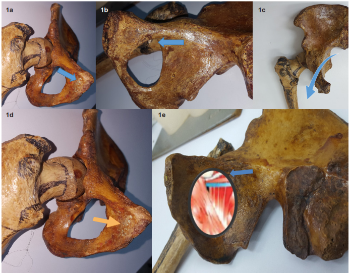 Anatom&iacute;a del agujero obturador: 1a y 1d: Cara externa de la pelvis menor. 1b y 1e: Cara interna pelvis menor, cubierto por el m&uacute;sculo obturador interno, permite el paso del paquete vasculo-nervioso obturador. Flecha azul: agujero obturador, borde inferior de la rama ilio-p&uacute;bica. Flecha naranja: rama isquio-p&uacute;bica.