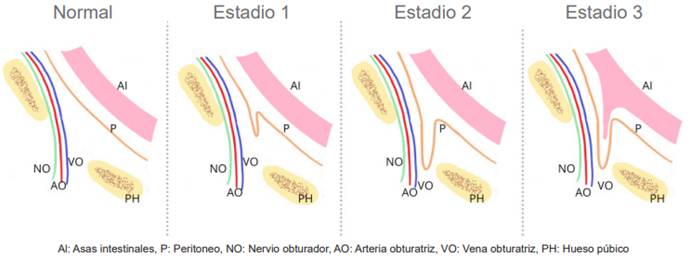Fisiopatolog&iacute;a de la hernia obturatriz,17,52.