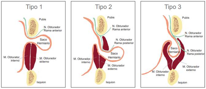 Clasificaci&oacute;n de la hernia obturatriz.3,52.
