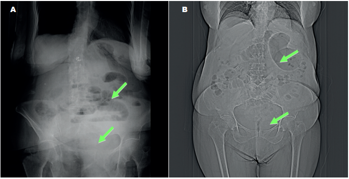 Radiograf&iacute;a simple de abdomen (A) y Tomograf&iacute;a computarizada (B), donde se aprecia distensi&oacute;n intestinal, con ausencia de gas en colon izquierdo y recto (Flechas). 