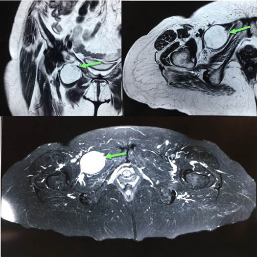 Resonancia magn&eacute;tica nuclear de pelvis que permite visualizar una hernia obturatriz tipo 2. Im&aacute;genes coronales y axiales T2 (arriba) y axial STIR (abajo) mostrando saco herniario distendido por l&iacute;quido entre m&uacute;sculos pect&iacute;neo y obturador externo derecho.
