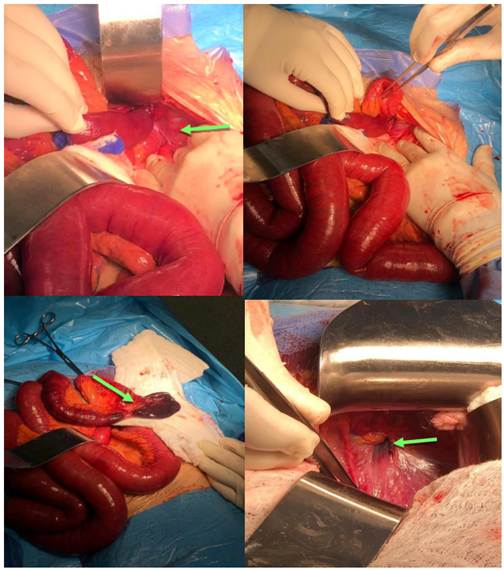 Reducci&oacute;n del asa intestinal delgada estrangulada a trav&eacute;s de un defecto de hernia obturatriz; obs&eacute;rvese la estrangulaci&oacute;n del yeyuno (flecha verde).