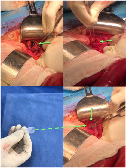 Disecci&oacute;n del saco herniario y correcci&oacute;n del defecto con t&eacute;cnica de tap&oacute;n de malla de polipropileno (flecha verde).