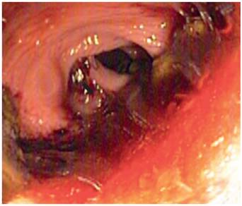 Rectosigmoidoscopia intraoperatoria donde se identificaron restos hem&aacute;ticos antiguos escasos (flecha negra) a 30 cm del borde anal, hasta la regi&oacute;n anorrectal.