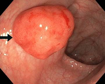 P&oacute;lipo pediculado de 2cm x 2cm de superficie lisa y cruenta, localizado en la parte antero-superior del sigmoides (flecha).