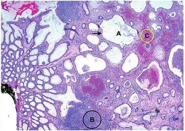 Tinci&oacute;n de hematoxilina-eosina 4X. Se observa la dilataci&oacute;n qu&iacute;stica glandular (flecha, A) con un extenso infiltrado inflamatorio en la l&aacute;mina propia (c&iacute;rculo negro, B) y cambios erosivos superficiales (c&iacute;rculo amarillo, C).