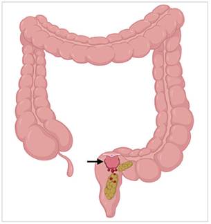 Representaci&oacute;n del mecanismo por el cual el paso de las heces lesiona la mucosa friable del p&oacute;lipo (flecha), lo que produce la sintomatolog&iacute;a cl&aacute;sica.