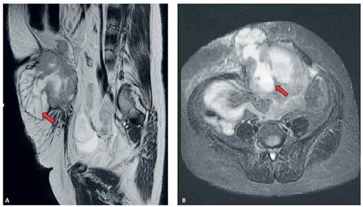 Se muestra corte sagital (A) y corte axial (B) de resonancia magnética nuclear en la región abdominopélvica de la paciente, donde se observa una masa tumoral que compromete el tejido celular subcutáneo y los tejidos blandos (flecha roja).