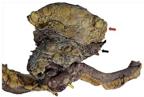 Espécimen de resección quirúrgica. De anterior a posterior, la flecha roja señala la piel y el tejido celular subcutáneo. La flecha negra muestra la masa tumoral adherida al tejido celular subcutáneo, músculo estriado esquelético y a la pared del intestino delgado. La flecha amarilla revela los implantes tumorales localizados en la serosa de la pared del intestino delgado.