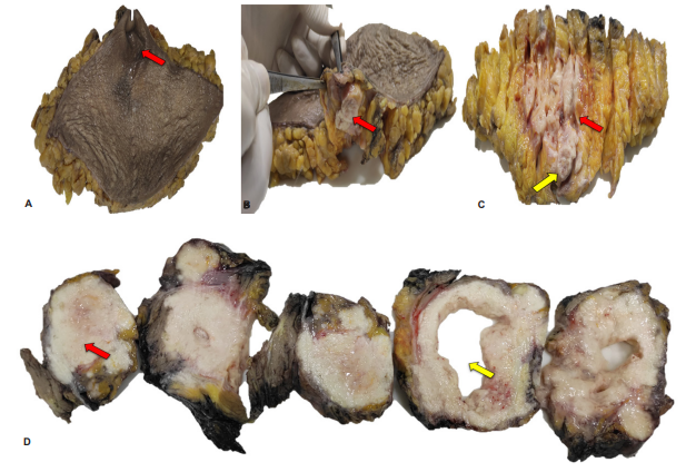 A. Elipse de piel de la pieza quirúrgica. La flecha roja señala el ombligo. B. Se expone el ombligo a nivel subcutáneo, el cual presenta una lesión neoplásica de color pardo claro. C. Elipse de piel con múltiples cortes seriados, la flecha amarilla muestra el ombligo, y de él se propaga la lesión tumoral, la cual compromete gran parte del tejido adiposo (flecha roja). D. Cortes seriados de la masa tumoral, la cual era de color pardo claro, con áreas sólidas (flecha roja) y áreas de degeneración quística (flecha amarilla).