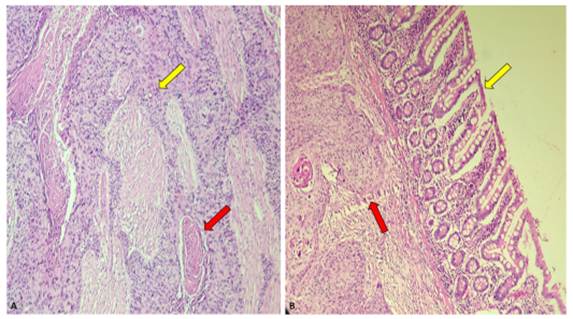 A. Fotomicrografía que muestran una neoplasia maligna compuesta por nidos de células escamosas (flecha amarilla) asociado a borlas de queratina (flecha roja). Hematoxilina y Eosina, 20x. B. Fotomicrografía que muestra representación de la mucosa del intestino delgado (flecha amarilla), la cual no está comprometida por tumor. En la submucosa se observan nidos tumorales de células escamosas con borlas de queratina (flecha roja).